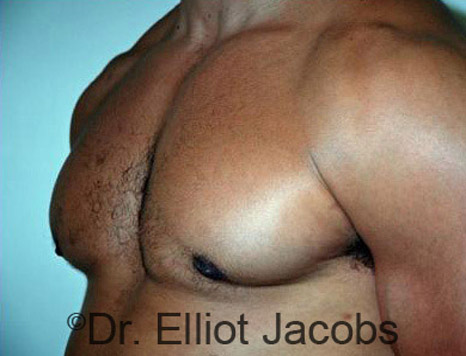 Men's breast, after Gynecomastia treatment in Bodybuilders, oblique view - patient 16