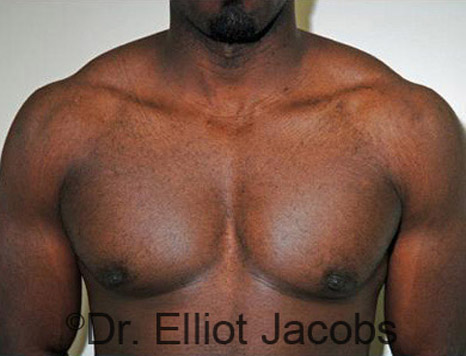Men's breast, after Gynecomastia treatment in Bodybuilders, front view - patient 17