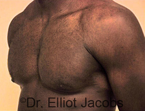 Men's breast, after Gynecomastia treatment in Bodybuilders, oblique view - patient 17