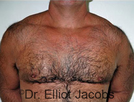 Men's breast, after Gynecomastia treatment in Bodybuilders, front view - patient 18