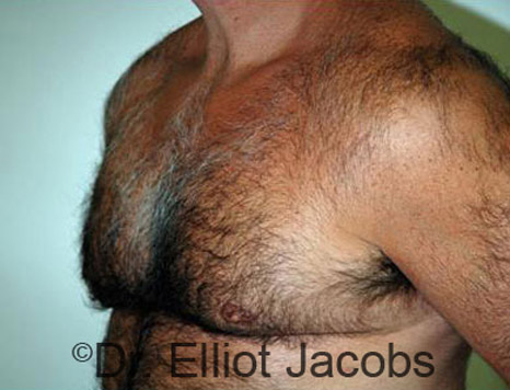 Men's breast, after Gynecomastia treatment in Bodybuilders, oblique view - patient 18