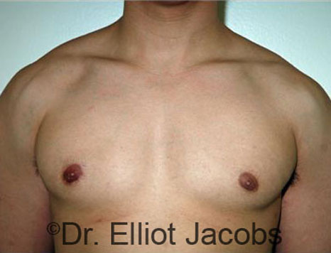 Men's breast, after Gynecomastia treatment in Bodybuilders, front view - patient 19