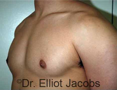 Men's breast, after Gynecomastia treatment in Bodybuilders, oblique view - patient 19