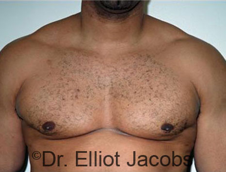 Men's breast, after Gynecomastia treatment in Bodybuilders, front view - patient 20