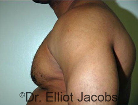 Men's breast, after Gynecomastia treatment in Bodybuilders, oblique view - patient 20