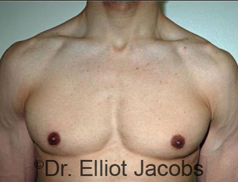 Men's breast, after Gynecomastia treatment in Bodybuilders, front view - patient 21