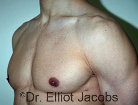 Men's breast, after Gynecomastia treatment in Bodybuilders, oblique view - patient 21