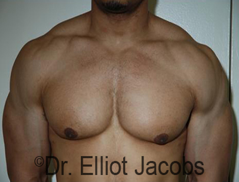 Men's breast, after Gynecomastia treatment in Bodybuilders, front view - patient 22