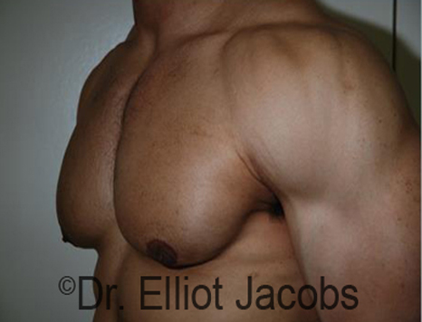 Men's breast, after Gynecomastia treatment in Bodybuilders, oblique view - patient 22
