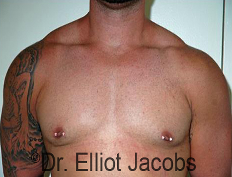 Men's breast, after Gynecomastia treatment in Bodybuilders, front view - patient 23