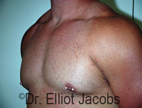 Men's breast, after Gynecomastia treatment in Bodybuilders, oblique view - patient 23
