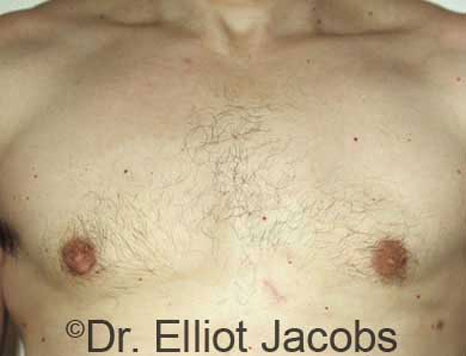 Male breast, after Gynecomastia treatment, front view, patient 13