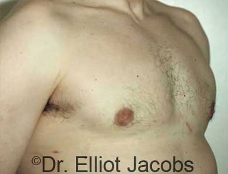 Male breast, after Gynecomastia treatment, r-side oblique view - patient 13
