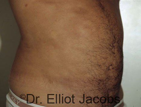 Male body, after Torsoplasty treatment, r-side oblique view, patient 1