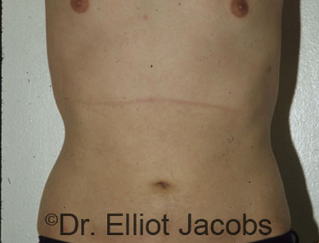 Male body, after Torsoplasty treatment, front view, patient 2