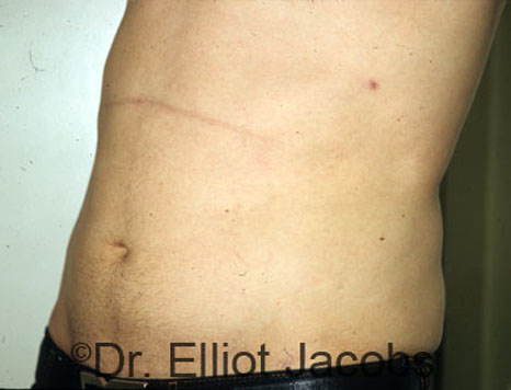 Male body, after Torsoplasty treatment, l-side oblique view, patient 2