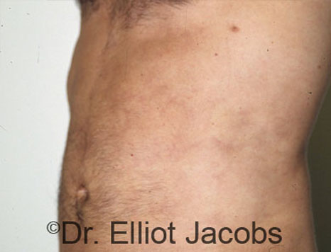Male body, after Torsoplasty treatment, l-side oblique view, patient 3