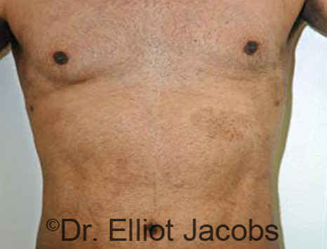 Male body, after Torsoplasty treatment, front view, patient 4