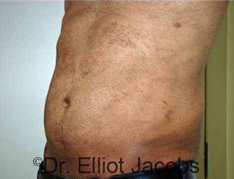 Male body, after Torsoplasty treatment, l-side oblique view, patient 4