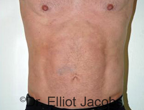 Male body, after Torsoplasty treatment, front view - patient 1