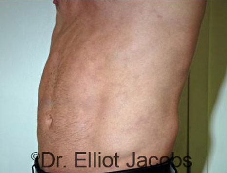 Male body, after Torsoplasty treatment, l-side oblique view, patient 5