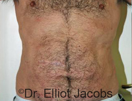 Male body, after Torsoplasty treatment, front view, patient 6