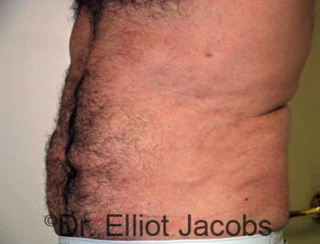 Male body, after Torsoplasty treatment, l-side oblique view, patient 6