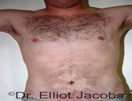 Male body, after Torsoplasty treatment, front view, patient 7