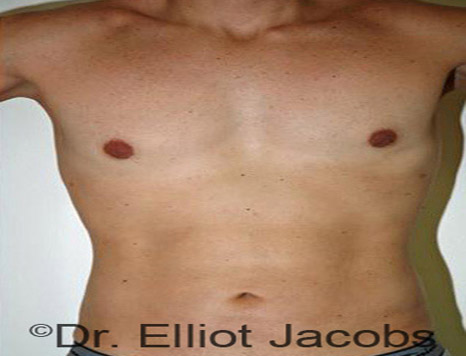 Male body, after Torsoplasty treatment, front view, patient 8