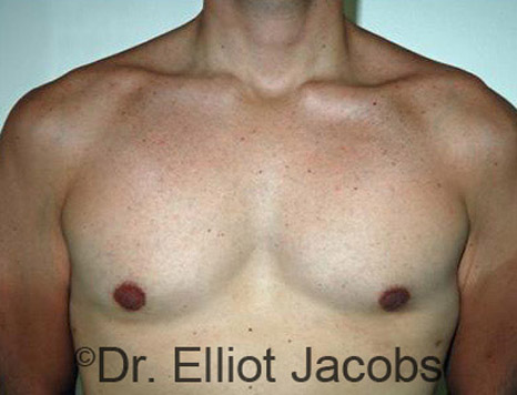Male body, after Torsoplasty treatment, front view - patient 8