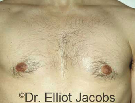 Male breast, after Gynecomastia treatment, front view, patient 14