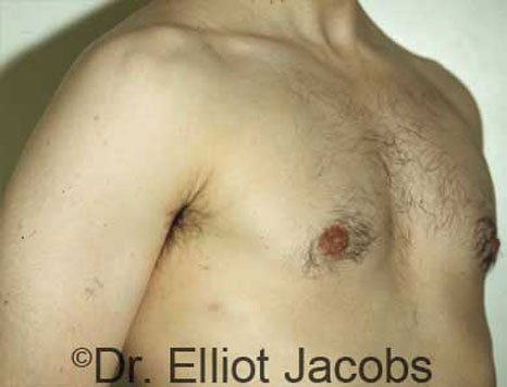 Male breast, after Gynecomastia treatment, r-side oblique view - patient 14