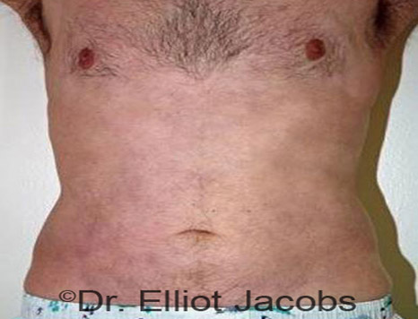 Male body, after Torsoplasty treatment, front view, patient 9
