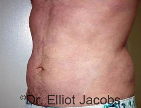 Male body, after Torsoplasty treatment, l-side oblique view, patient 9