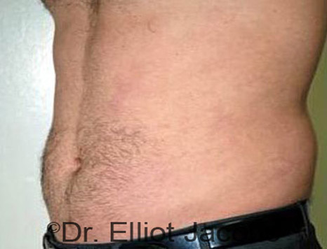 Male body, after Torsoplasty treatment, l-side oblique view, patient 10