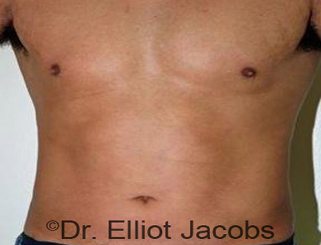 Male body, after Torsoplasty treatment, front view, patient 11