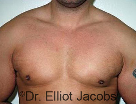 Male body, after Torsoplasty treatment, front view - patient 11