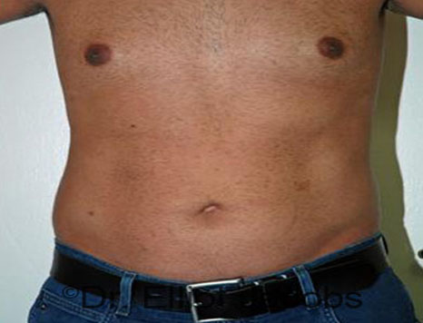 Male body, after Torsoplasty treatment, front view, patient 12
