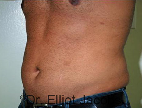 Male body, after Torsoplasty treatment, l-side oblique view, patient 12
