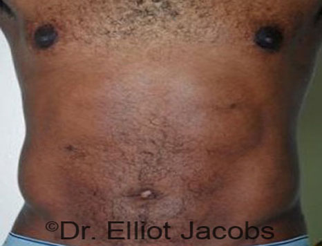 Male body, after Torsoplasty treatment, front view, patient 13