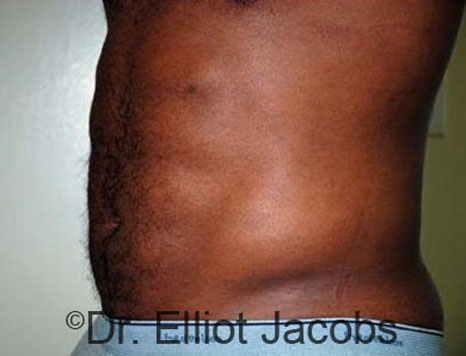 Male body, after Torsoplasty treatment, l-side oblique view, patient 13