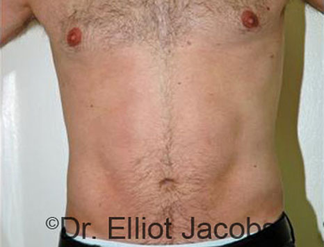 Male body, after Torsoplasty treatment, front view, patient 14