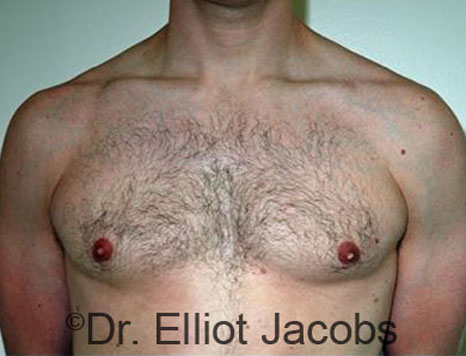 Male body, after Torsoplasty treatment, front view - patient 14