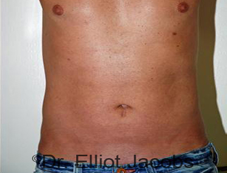 Male body, after Torsoplasty treatment, front view - patient 3