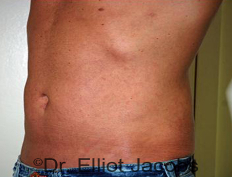 Male body, after Torsoplasty treatment, l-side oblique view, patient 15
