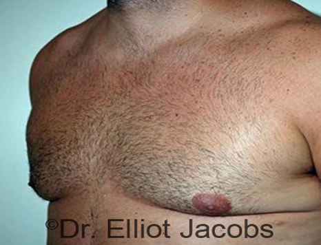 Male body, after Torsoplasty treatment, l-side oblique view, patient 16