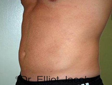 Male body, after Torsoplasty treatment, l-side oblique view, patient 17