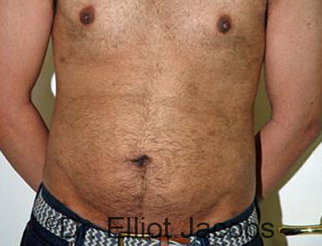 Male body, after Torsoplasty treatment, front view, patient 18