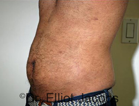 Male body, after Torsoplasty treatment, l-side oblique view, patient 18