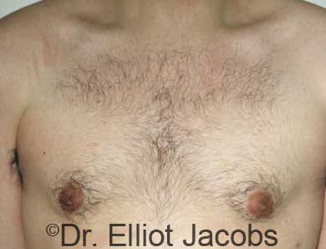 Male breast, after Gynecomastia treatment, front view, patient 15